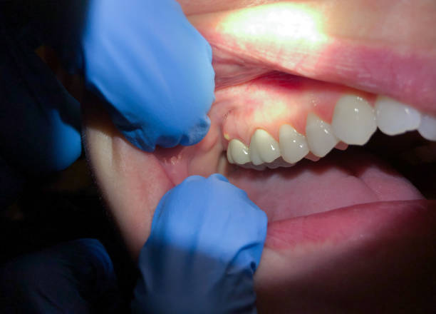 Best Dentist for Tooth Abscess  in Spring Grove, MN